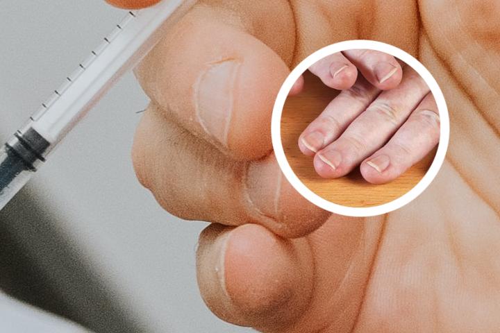 白癜风皮肤移植后长出来还是白的