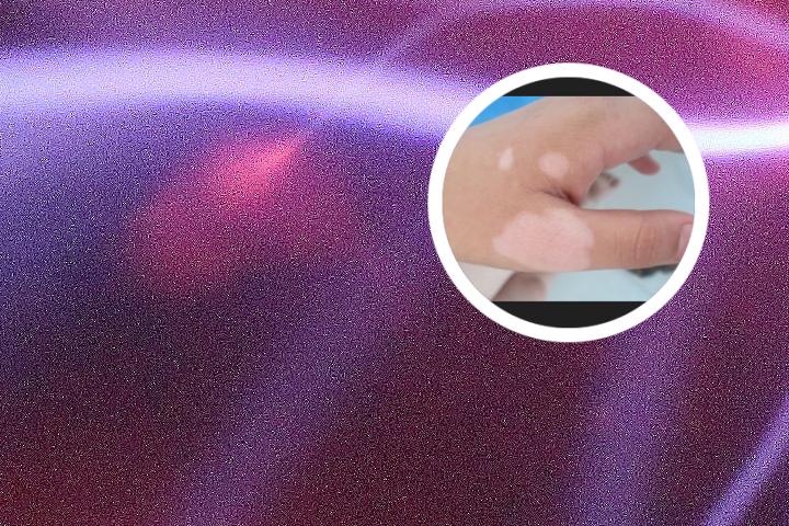 白癜风可以吃蜂胶胶囊吗