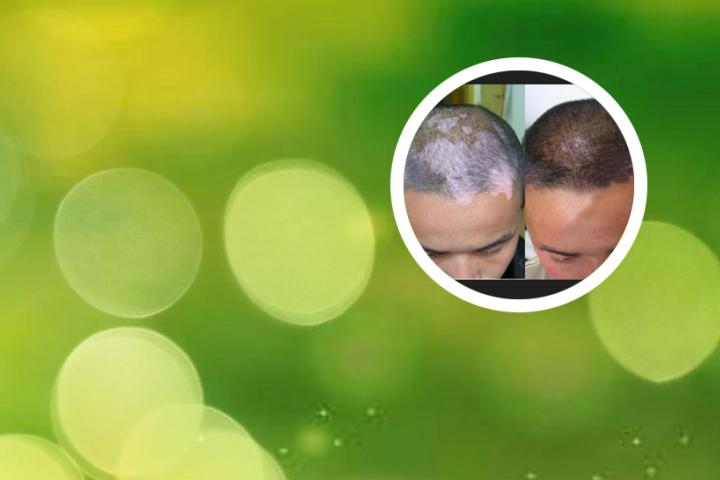 白癜风扩散期能喝啤酒吗