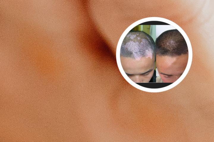 白癜风能告别复发吗