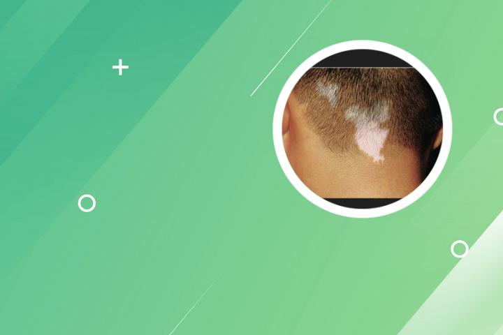 白癜风可以吃草莓吗