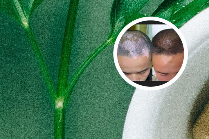 白癜风可以用西瓜霜