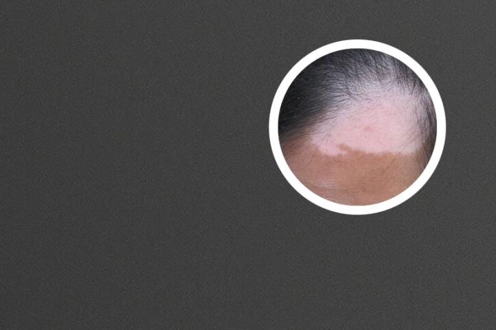 艾叶水泡脚能治疗白癜风吗