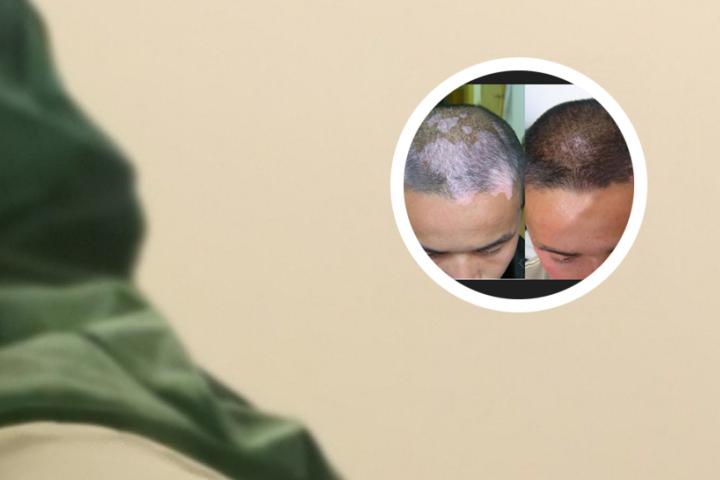 白癜风完全脱色需要的时间