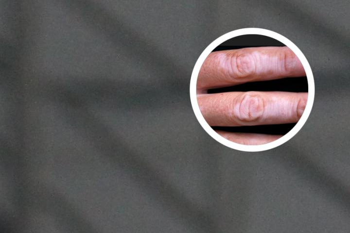 白癜风的人情绪如何