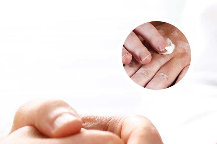 白癜风都不能吃什么蔬菜