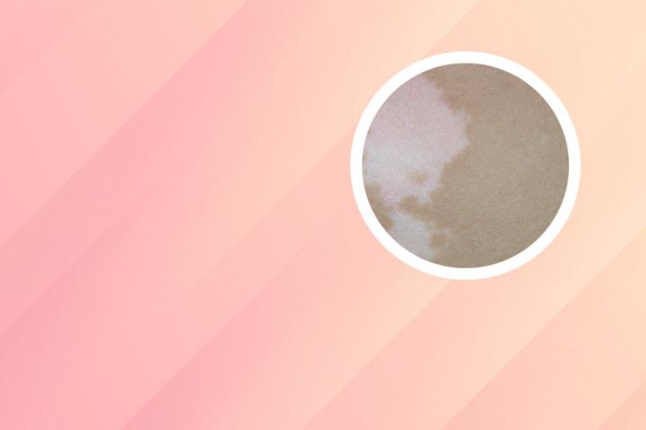 白癜风什么东西能吃