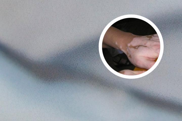 白癜风不是夏天会扩散吗