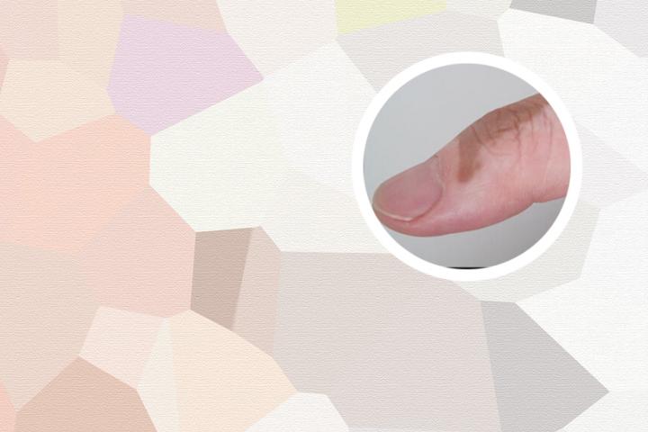 白癜风能剖腹产吗