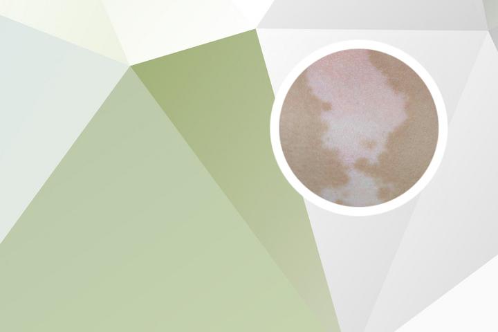 白癜风喝蒲公英水有用吗