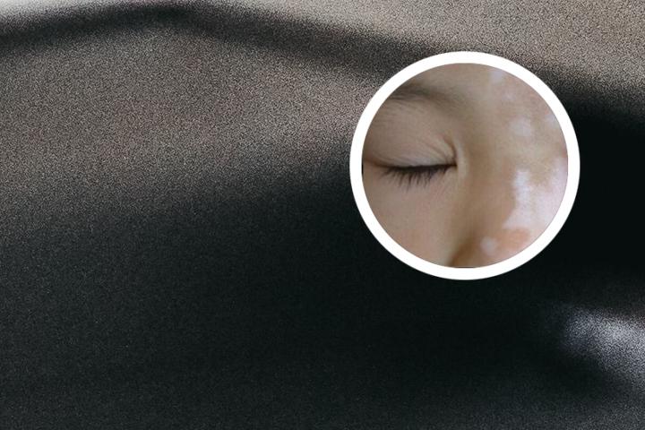 白癜风博主