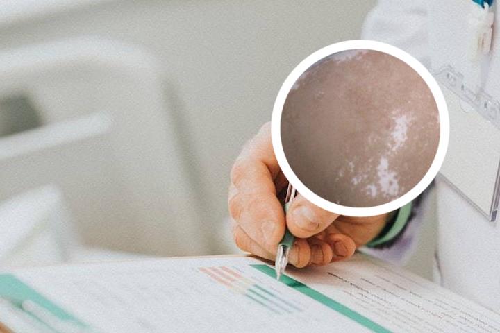 白癜风积液可以用什么代替
