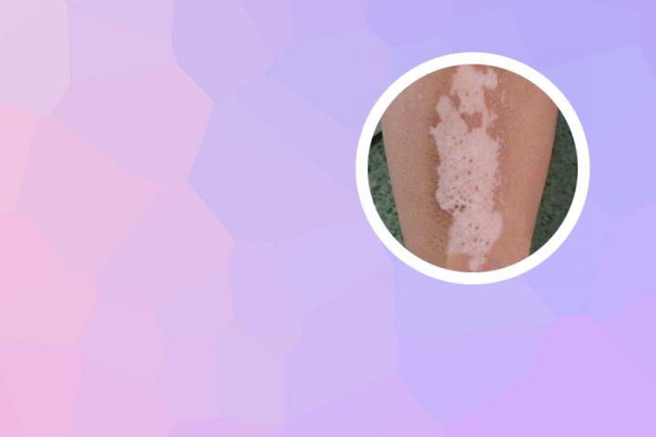 白癜风皮肤上有纹理吗
