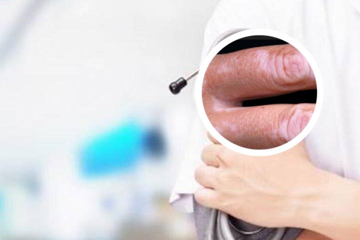 白癜风常识判断眼型软件