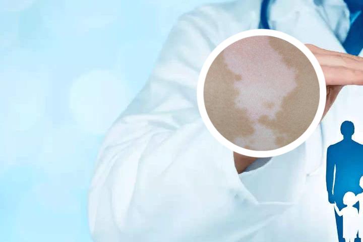 白癜风能控制不扩散吗