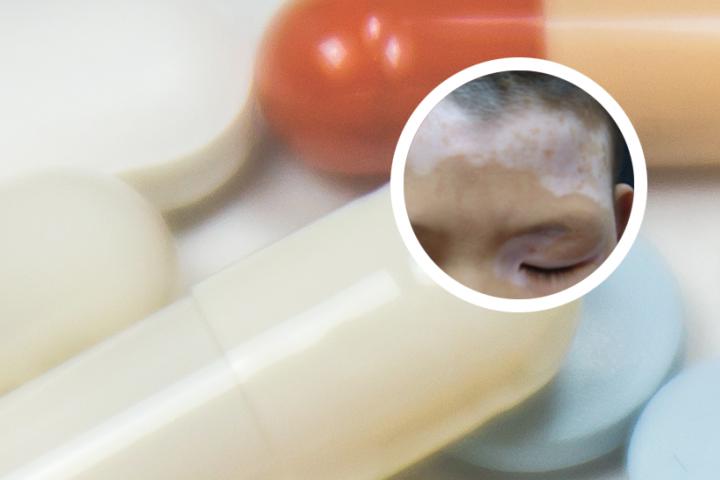 白癜风外用药使用注意事项