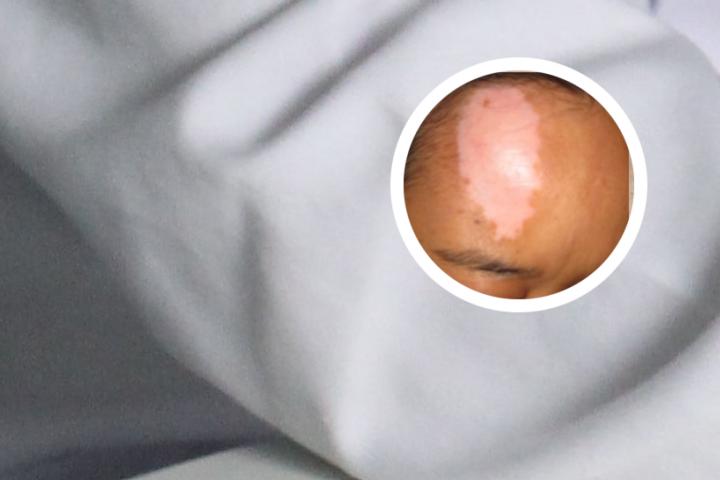 孩子腿上有白斑是白癜风吗