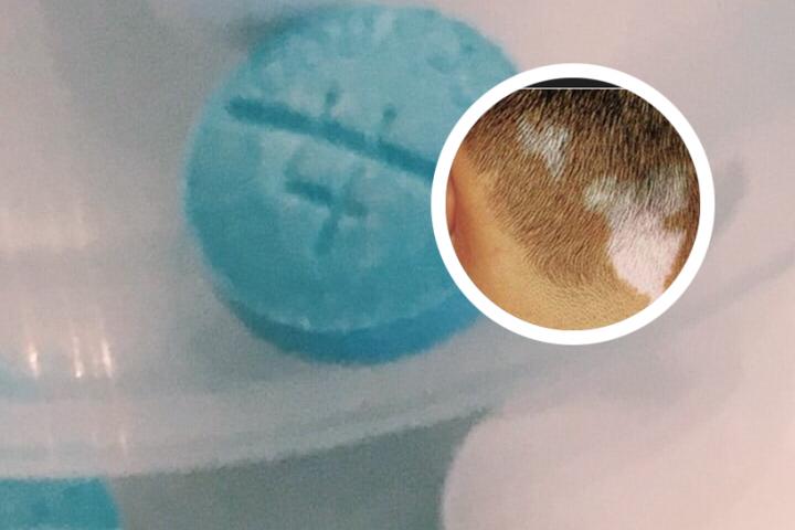 白癜风会因为抑郁引起吗