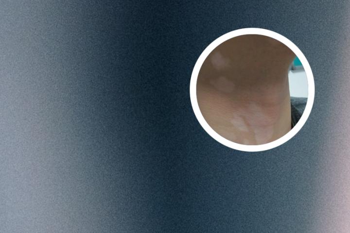 白癜风病初期用什么药