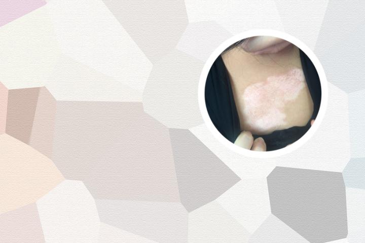 白癜风患者冬天可以用大宝护肤吗