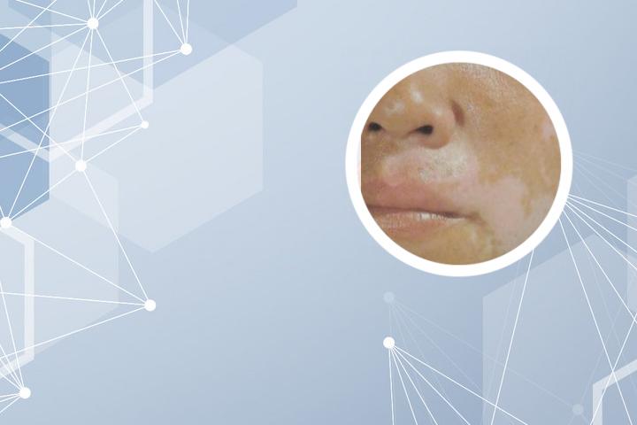 白癜风光抹补水的可以吗