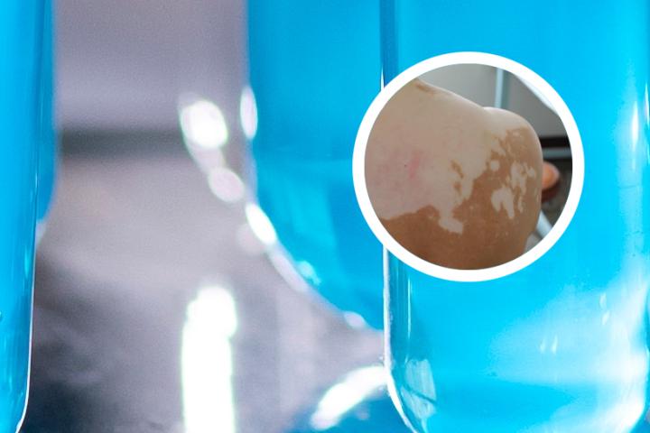 白癜风能喝冰红茶吗
