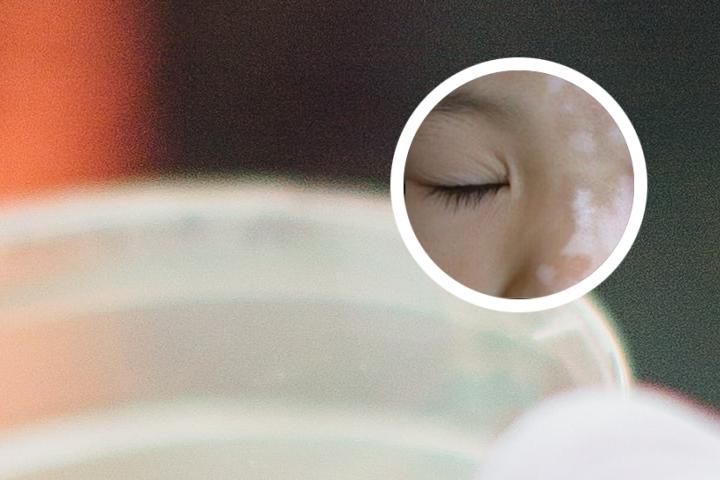 白癜风抹卤米松软膏多久能好
