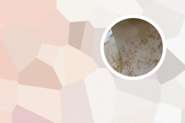 白癜风的饮食禁忌