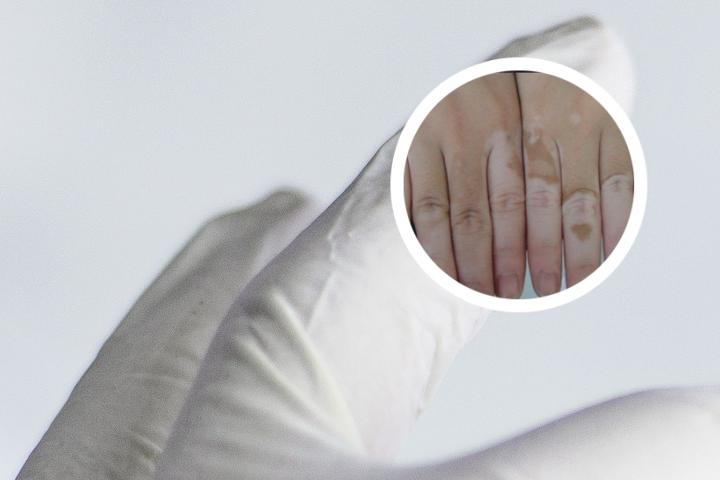 白癜风病人能吃枣吗