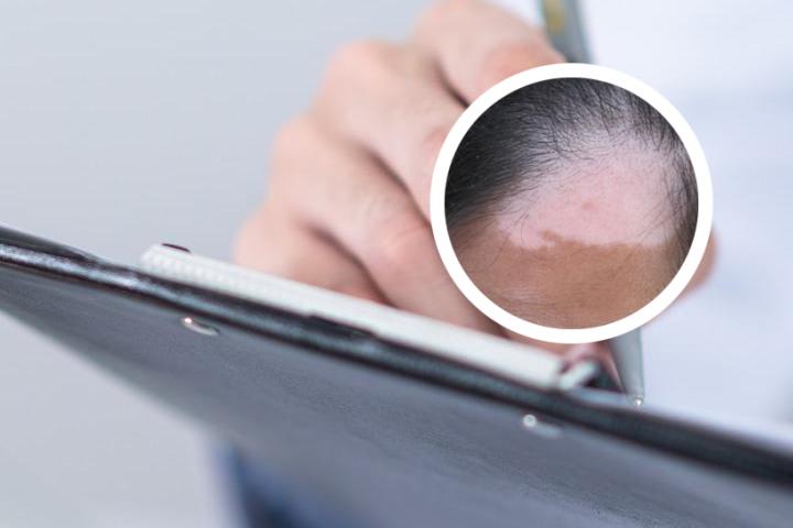 白癜风可以吃褪黑素药吗