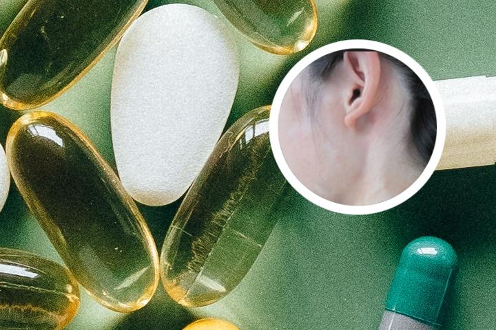 白癜风抹了药怎么长了好多痘痘