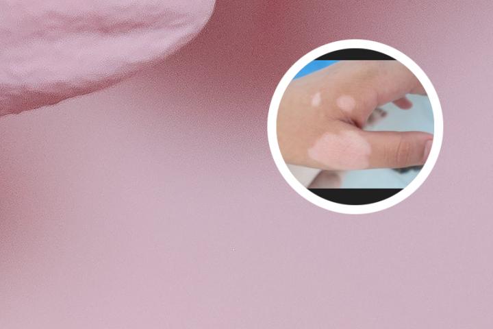 白癜风迷信说法