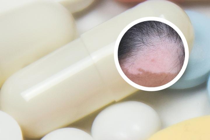 白癜风不能吃什么东西要注意什么