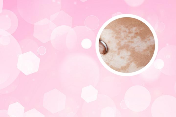 白癜风能吃烧鸡公吗