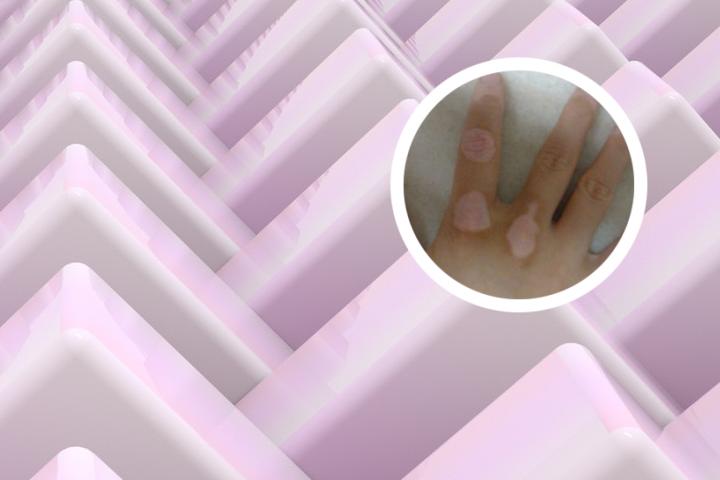 白癜风会从包皮开始吗