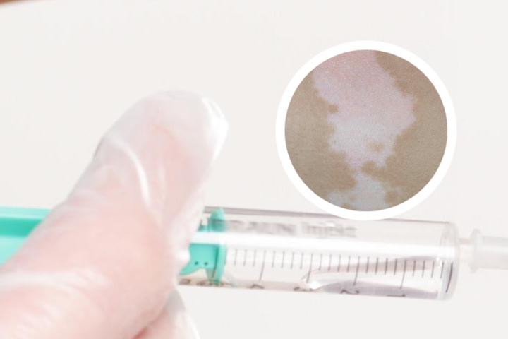 艾叶灰可以治疗白癜风吗
