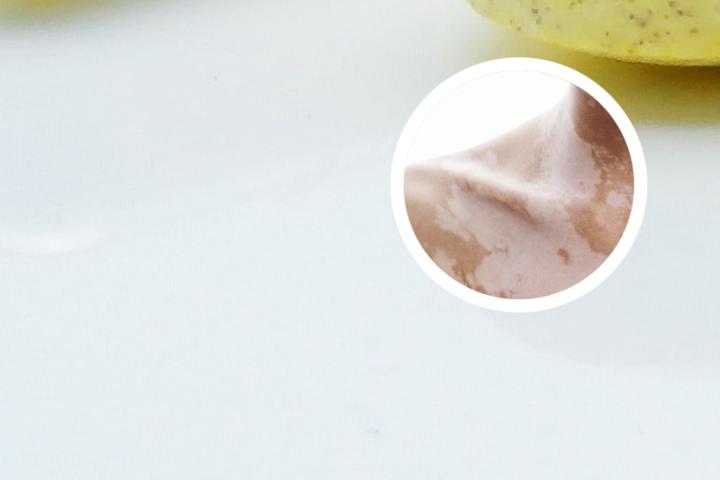 白癜风的最佳发病时间