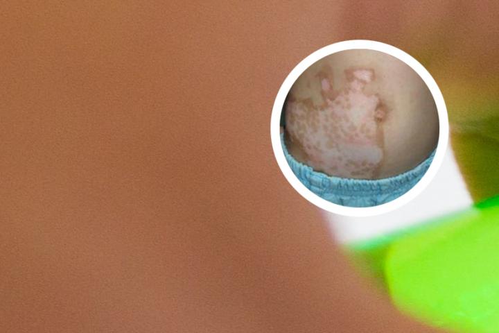 白癜风吃维生素b族有用吗