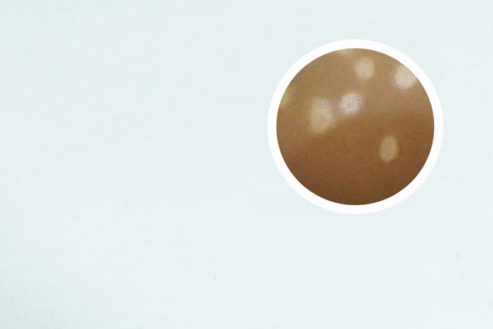 白癜风傅雯雯308