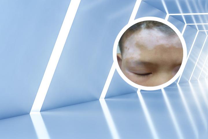 白癜风可以吃姜和蒜吗