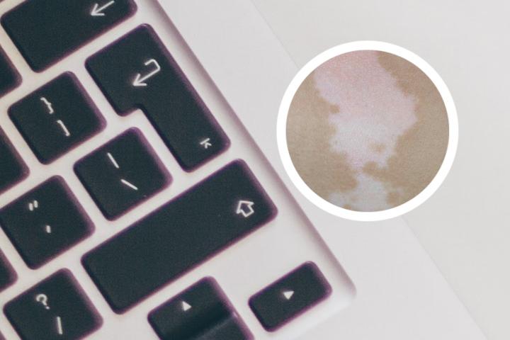 白癜风衡慧宝能报销吗