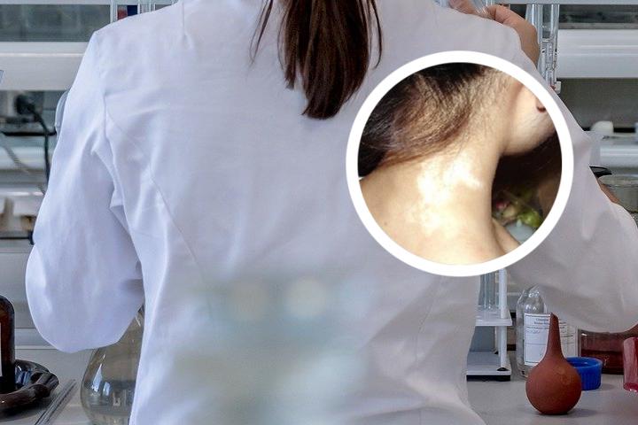 白癜风复色用什么