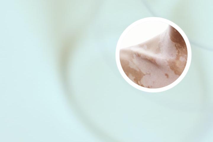 白癜风好了后多久能怀孕