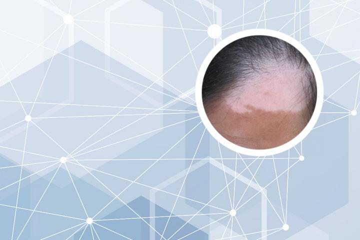 白癜风扩大有征兆吗