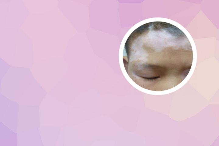 白癜风恢复阶段