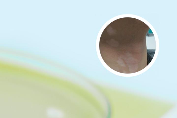 补骨脂能冶疗白癜风吗