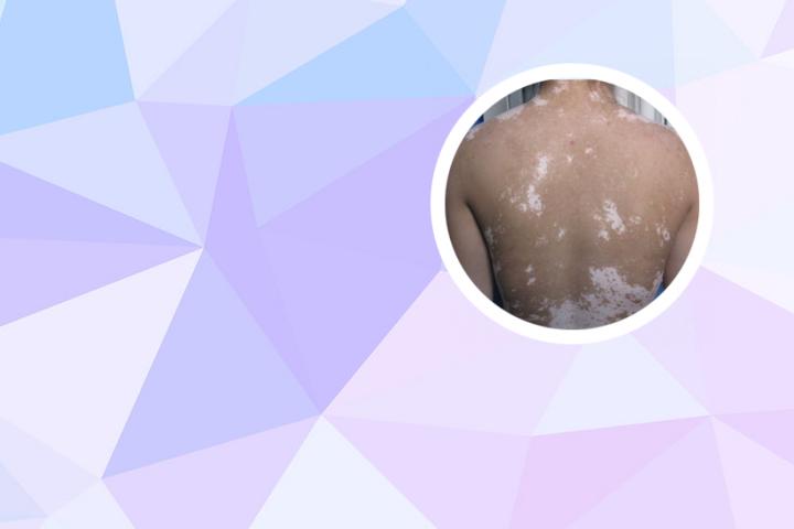 白癜风可以榄角