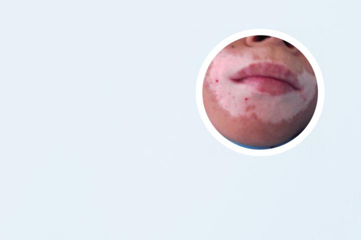 白癜风患者适合吃什么鱼