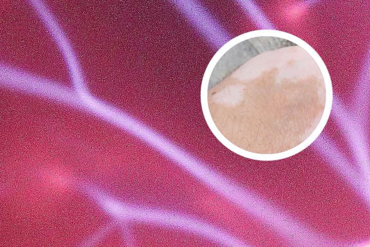 白癜风白斑变小变暗