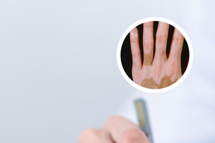 白癜风不能吃什么东西要注意什么